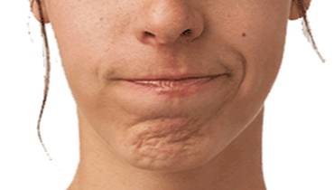 Botulinum Toxin Treatment Recommended by Dr. Yeung Ho Hong 楊浩康