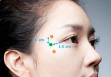 Botulinum Toxin Treatment Recommended by Dr. Yeung Ho Hong 楊浩康
